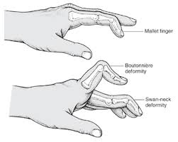 hand deformity