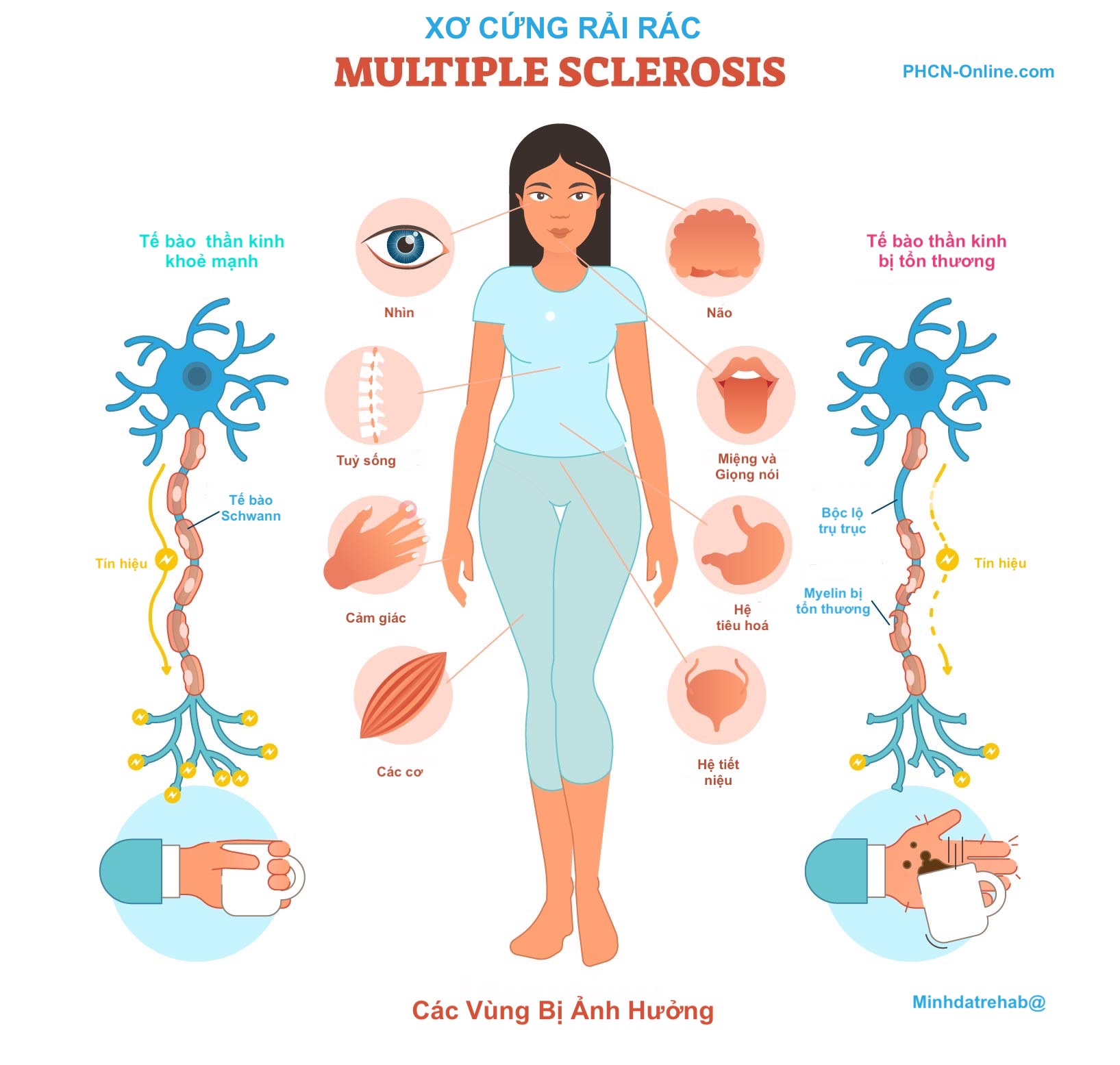 xơ cứng rải rác