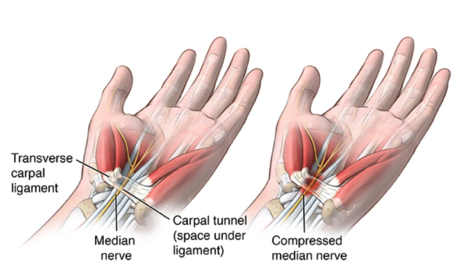 hội chứng cổ tay