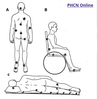 Các vị trí loét ép