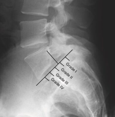 phân độ trượt đốt sống