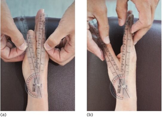 ROM dạng CMC ngón cái