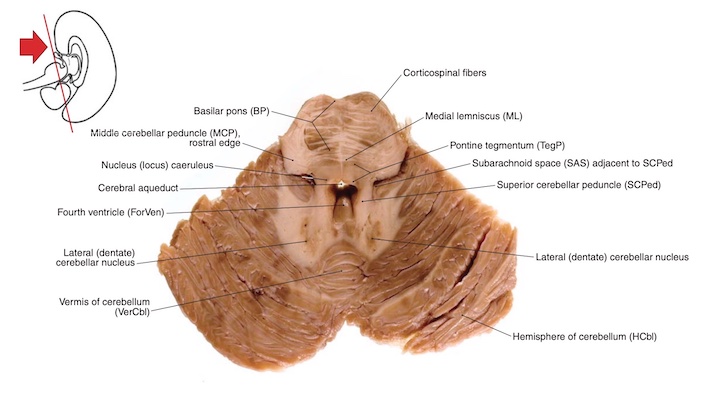 Cắt ngang cầu não
