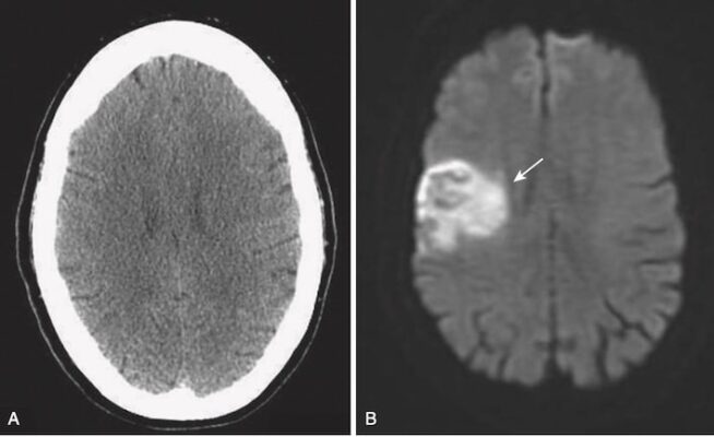 CT và MRI Đột quỵ cấp