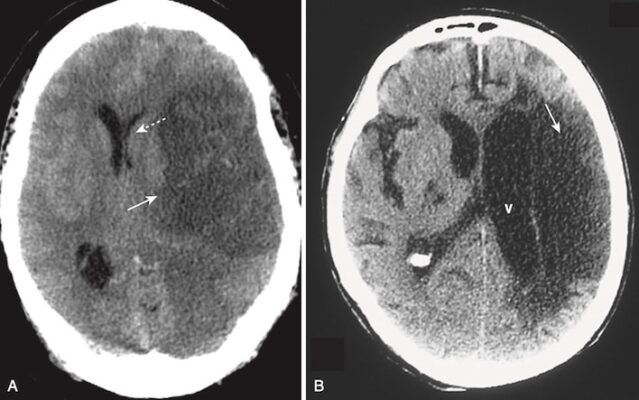CT đột quỵ xuất huyết mới và cũ
