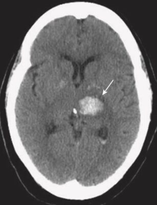 Xuất huyết nội sọ cấp tính