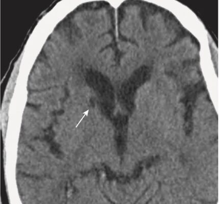 Nhồi máu ổ khuyết