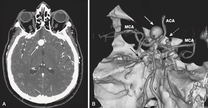 CT vỡ phình mạch dạng túi