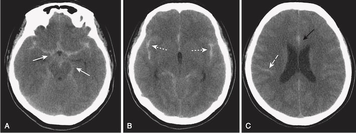 Xuất huyết dưới nhện, CT