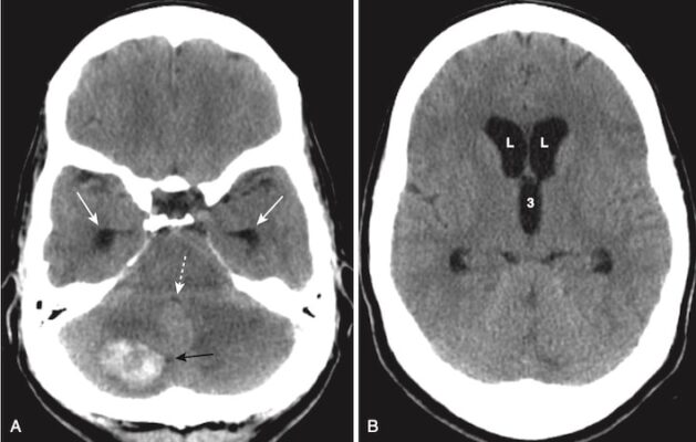 Não úng thuỷ không thông