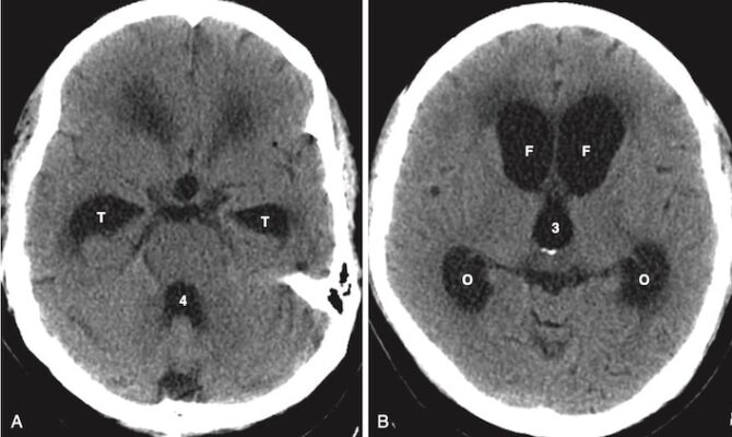 Não úng thuỷ thông