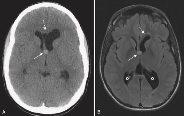 U nang dạng keo, Ct và MRI