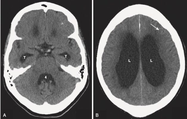 Não úng thuỷ áp lực bình thường