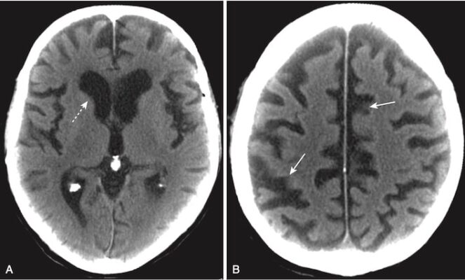 Teo vỏ não lan toả