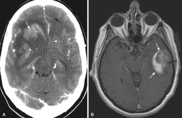 U tế bào thần kinh đệm đa dạng