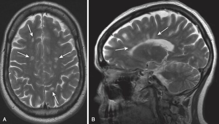 Xơ cứng rải rác, MRI