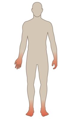 Hình 3. Phân bố mất cảm giác kiểu bít tất và găng tay