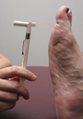 HÌnh 7. Khám cảm giác bảo vệ với sợi cước monofilament