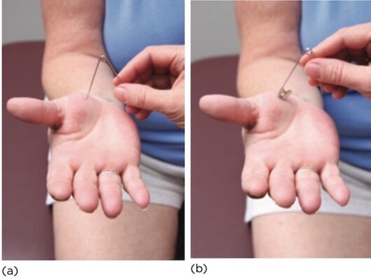 Hình 9. Khám cảm giác đầu nhọn và đầu tù