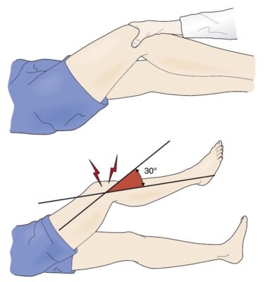 Hình 3 Nghiệm pháp Noble để xác định xem có ma sát của dải chậu chày ở đầu gối.