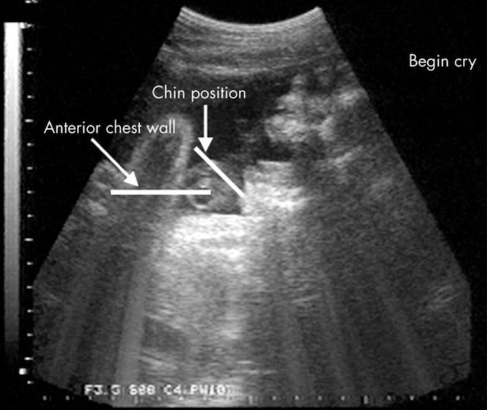 Ảnh siêu âm này cho thấy một đứa trẻ đang thực hiện một loạt các động tác khóc, ngoại trừ tiếng khóc không được nghe thấy.