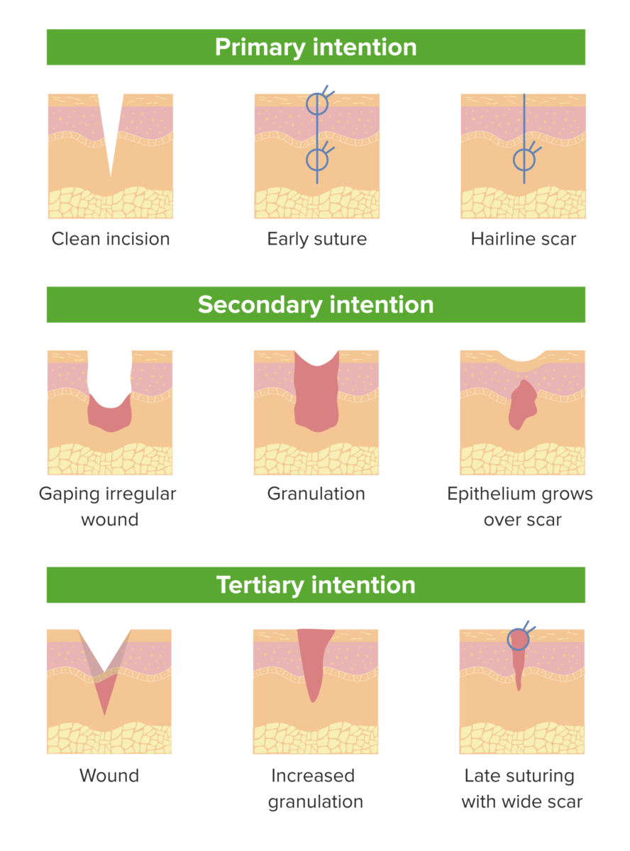 Hình: Các dạng đóng vết thương