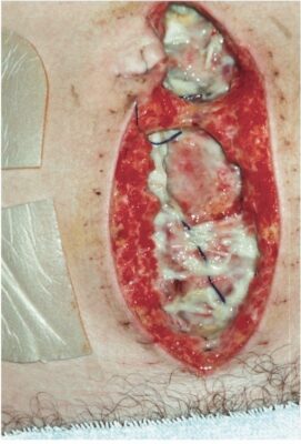 Hình Vết thương bị tách hở ra (dehiscence) sau khi cắt ruột thừa.