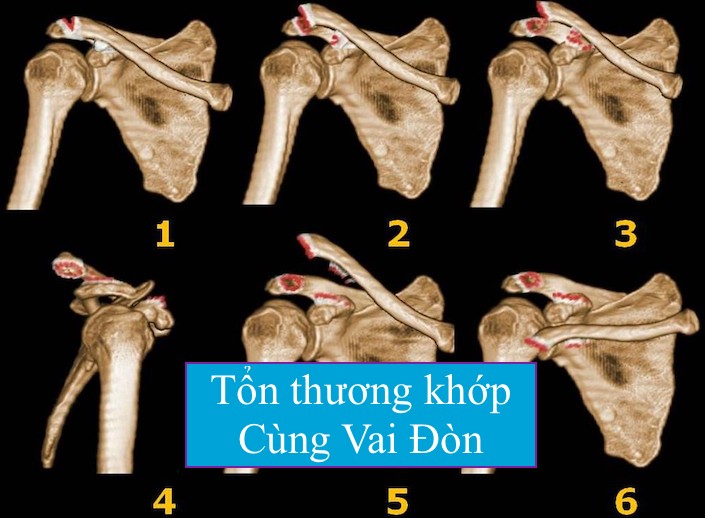 Các kỹ thuật điều trị gãy xương đòn