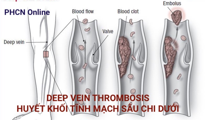 7. Biến Chứng Nguy Hiểm Của Huyết Khối Tĩnh Mạch Sâu