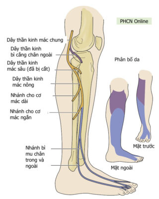 Hình 1: Phân bố cảm giác và vận động của dây thần kinh mác chung (màu tím) và mác nông (xanh). 