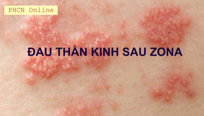 4. Biến Chứng của Zona Thần Kinh