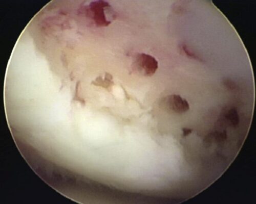 Tổn thương sụn khớp gối và các kỹ thuật can thiệp