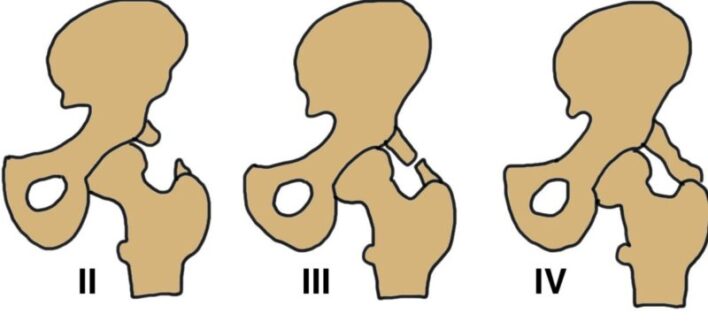 HIỂU ĐÚNG VỀ CỐT HÓA LẠC CHỖ