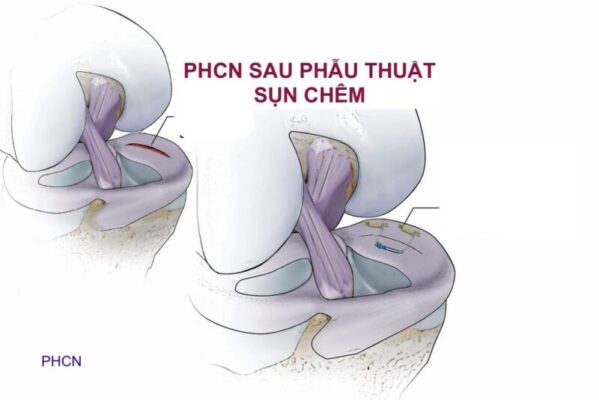 SINH CƠ HỌC & PHỤC HỒI SAU PHẪU THUẬT SỤN CHÊM