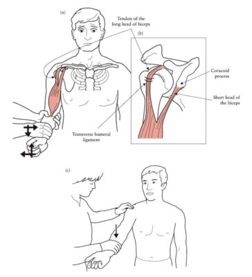 Hình ảnh này chưa có thuộc tính alt; tên tệp của nó là test-biceps-yergason-364x400.jpeg